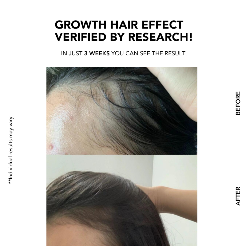 Anti-Hair Loss Scalp Shampoo 300ml|Hair Growth|Anti Hair Loss|Hair Loss Control|Oily Scalp | 防脱控油洗发水 | 脱发 |掉发