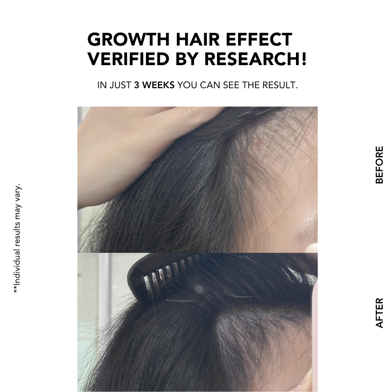 Anti-Hair Loss Scalp Shampoo 300ml|Hair Growth|Anti Hair Loss|Hair Loss Control|Oily Scalp | 防脱控油洗发水 | 脱发 |掉发