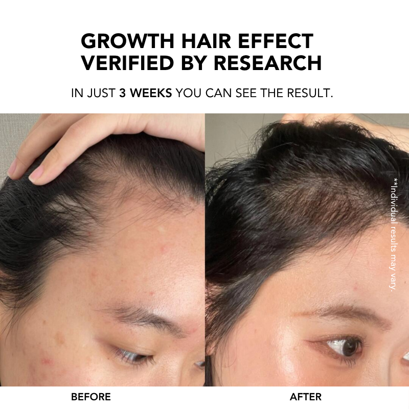 Root Enhancer Hair Tonic 100ml|Hair Growth Serum|Anti Hair Loss|Hair Loss Control|Hair Growth|Scalp Tonic 生发液